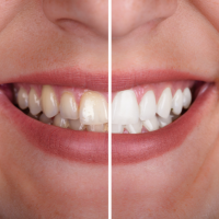 Blanqueamiento dental